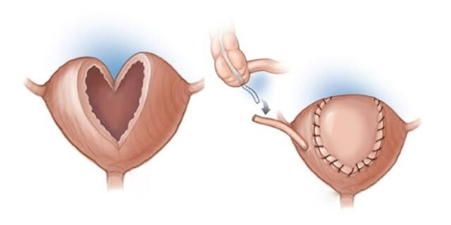 Augmentation Cystoplasty, Reconstructive Urology Specialist Gurgaon