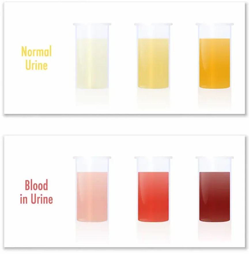 Blood in Urine